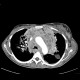 Melanoma of mediastinum: CT - Computed tomography